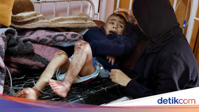 Potret Anak-anak Gaza yang Menderita Gizi Buruk