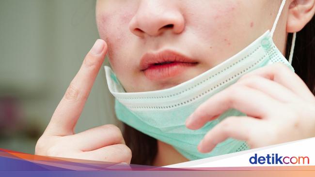 Mengenal 'Maskne', saat Jerawat Muncul karena Keseringan Pakai Masker