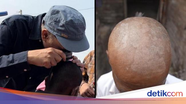 Misteri Kerontokan Rambut Massal Menimpa Penduduk Desa di India