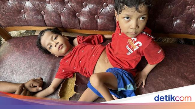 Kisah Kembar Siam Hidup dengan Perut Menyatu, Tetap Tegar Terima Takdir