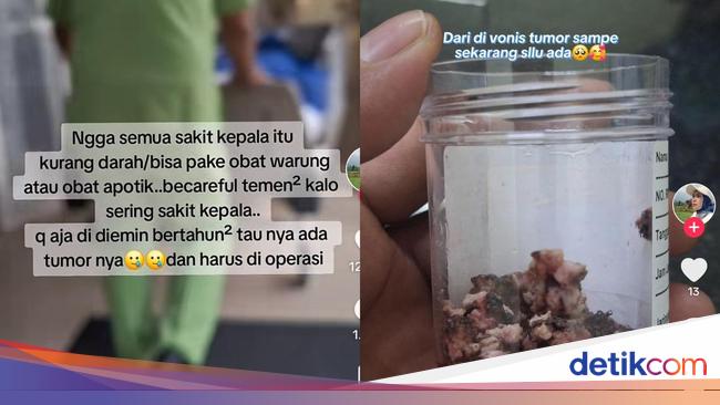 Viral Wanita di Jateng Ngeluh Sakit Kepala, Tak Tahunya Kena Tumor Otak