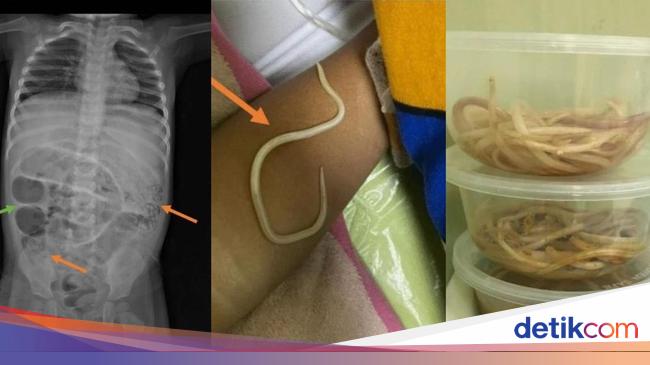 Begini Wujud Cacing 35 Cm yang Ditemukan Dalam Perut Bocah 3 Tahun di ...