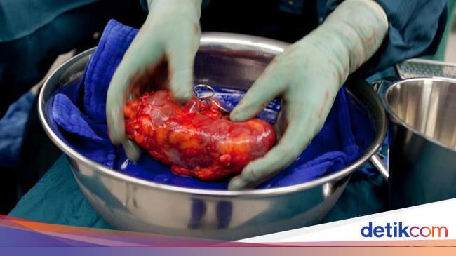 Jual Ginjal, Mengungkap Jaringan Perdagangan Organ Global