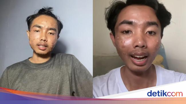 Viral Thrift Clothes Skin Pain