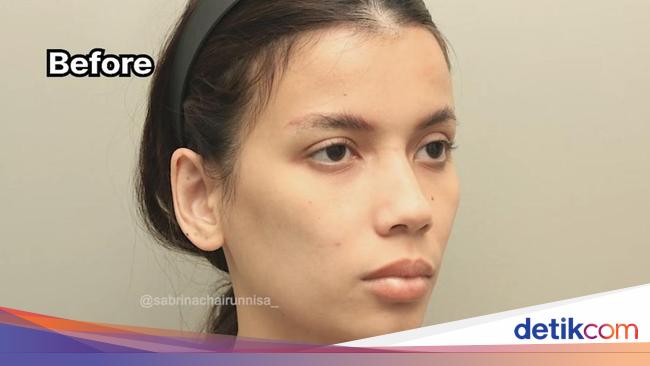 7 Foto Before-After Sabrina Istri Deddy Corbuzier Jalani Fat Graft