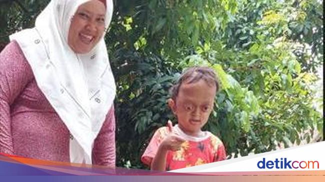 Kisah Si Kecil Aufan Derita Hidrosefalus, Crouzon Syndrome hingga Spina Bifida