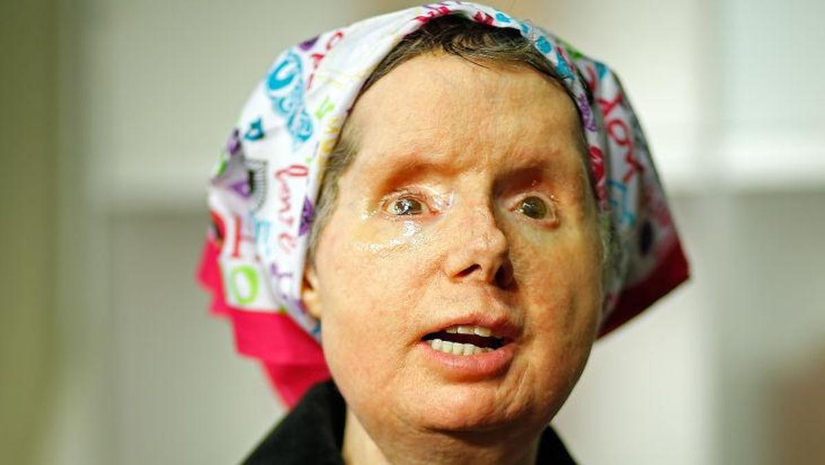 Foto Wanita Jalani Transplantasi Wajah, Mukanya Hancur Parah Diserang Simpanse