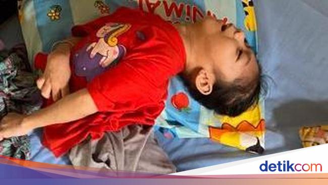 Kisah Pilu Andini, Anak Pencari Ikan yang Alami Cerebral Palsy
