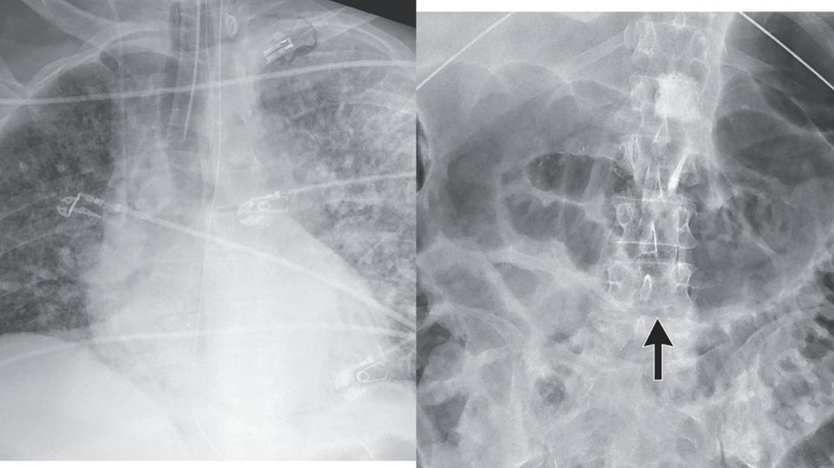 Merinding! 2 Tubuh Pasien Ini Dipenuhi Cacing Setelah Terima Donor Ginjal