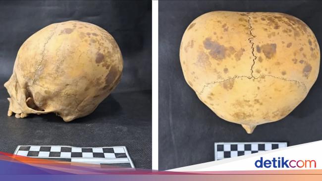 Tengkorak Anak Berwujud Aneh Dikira Alien, Ini Faktanya