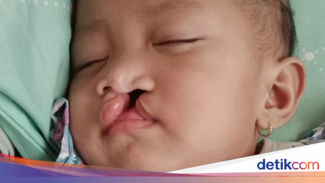 Balita Khalisa Masih Perlu 3 Kali Operasi Bibir Sumbing, Ayo Bantu