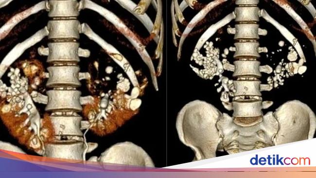 何百もの石の物語は、悪い習慣の男の腎臓に落ち着きます