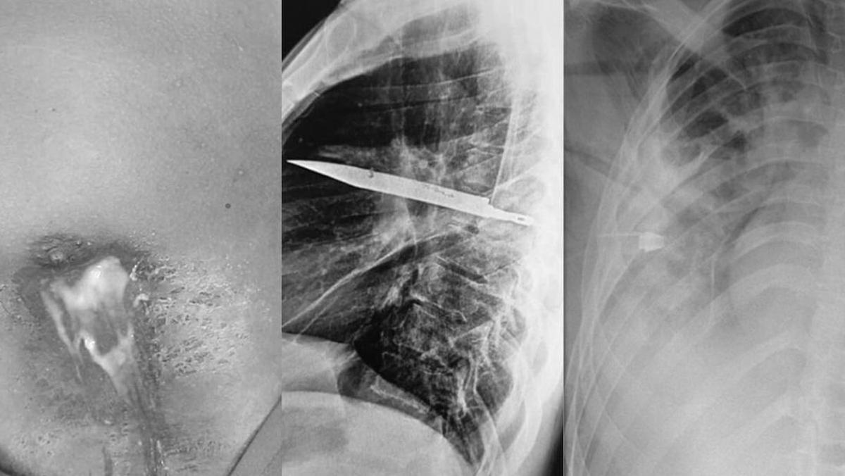 Pria Ini Keluhkan Payudara Bernanah, Ternyata Ada Pisau Nyangkut di Dalamnya