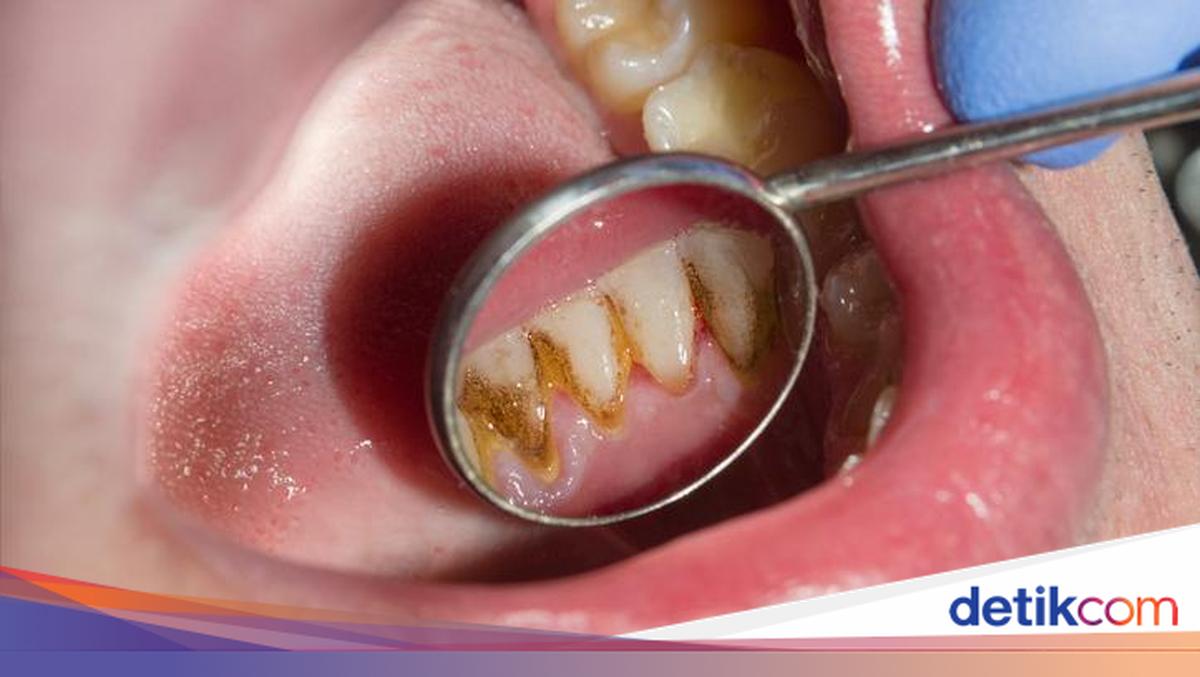 Ew! 7 Makanan dan Minuman Ini Bikin Karang Gigi Cepat Numpuk Ew! 7 Makanan dan Minuman Ini Bikin Karang Gigi Cepat Numpuk
