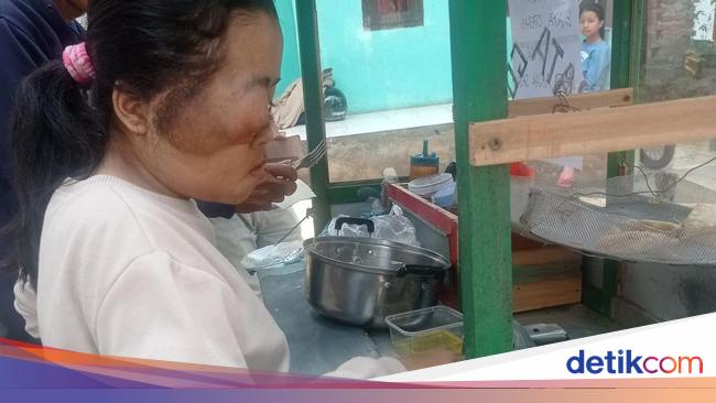 Yuk Bantu Resti, Anak Tukang Batagor Penderita Tumor Butuh Uluran Tangan