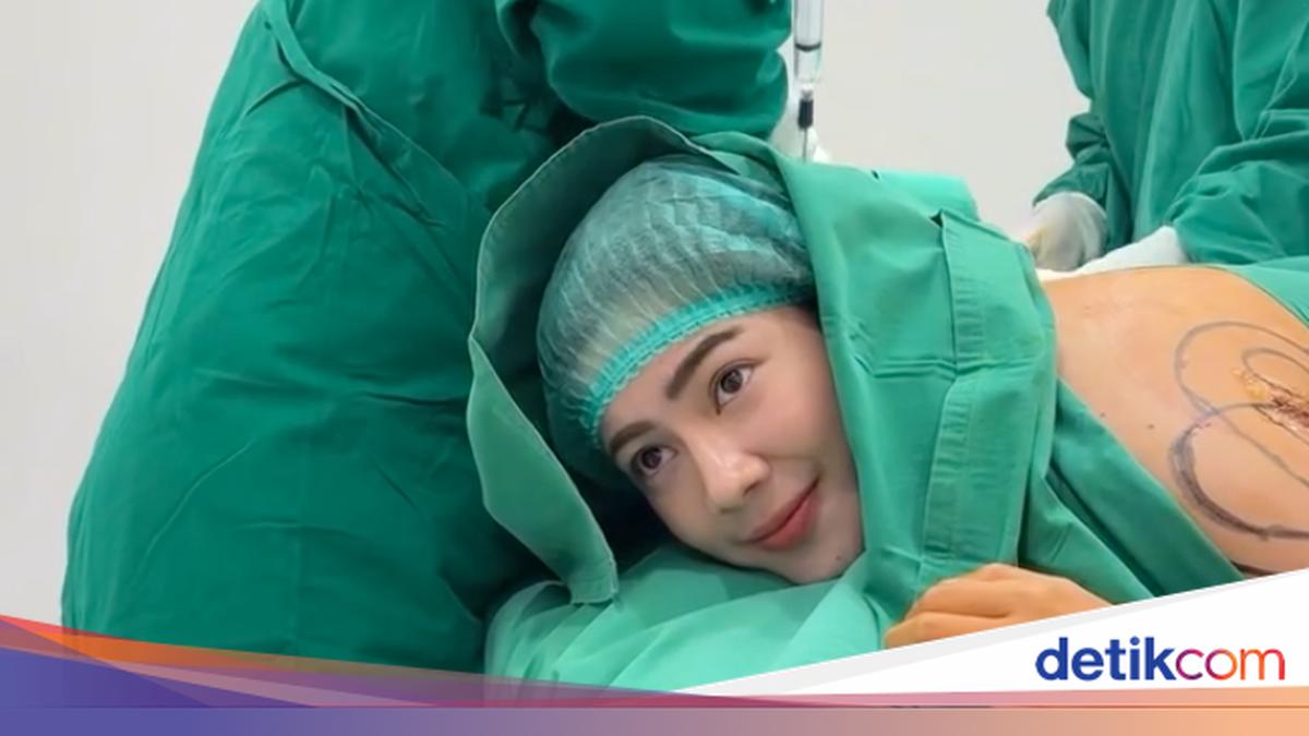 8 Foto Felicya Angelista Jalani Sedot Lemak, Makin Langsing Turun BB 2 Kg