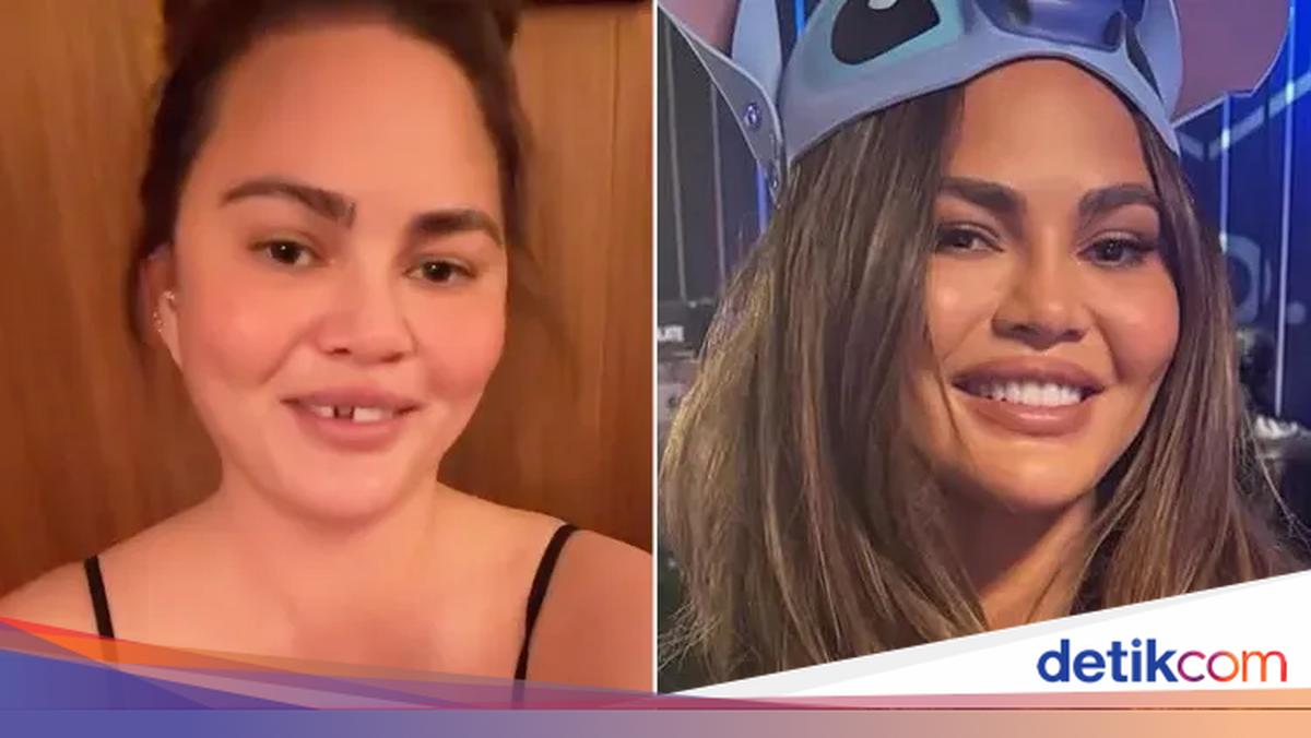 Chrissy Teigen alami insiden setelah berlibur bersama anak-anaknya. Giginya copot usai coba menggigit permen tongkat khas Natal yang dibuatnya. ?