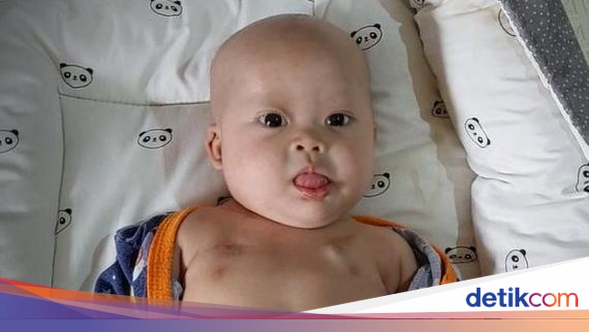 Kisah Chiara Bayi Penderita Tumor Teratoma Immature, Berjuang Ingin Sembuh