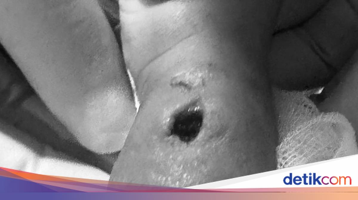 Tangan Bayi Berlubang Diduga Korban Malpraktik, RS di Makassar Buka Suara
