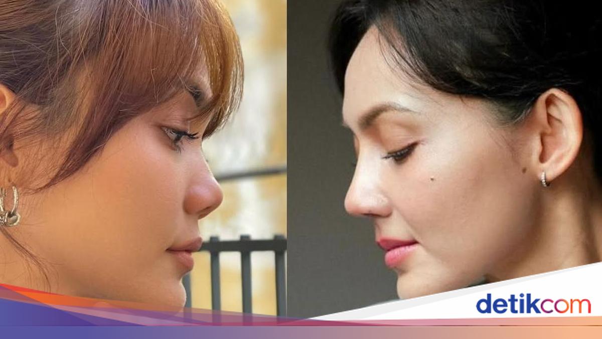 Rina Nose Perlihatkan Before-After Hidung Usai Oplas, Pangling Gak?