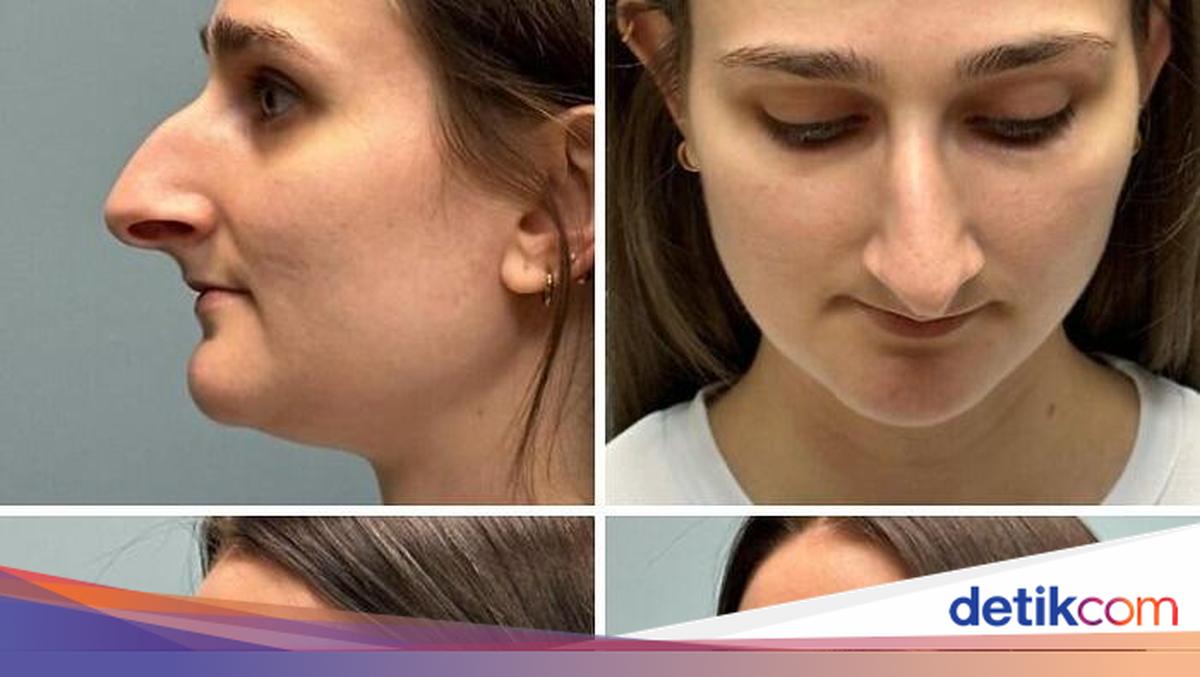 10 Before-After Operasi Plastik dengan Hasil Mengagumkan