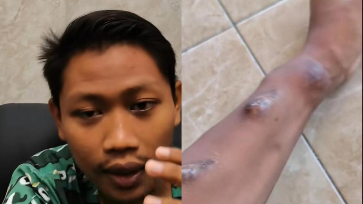 Viral Pria Tuban Idap Gagal Ginjal di Usia 20-an, Mengaku Keseringan Makan Mi Instan