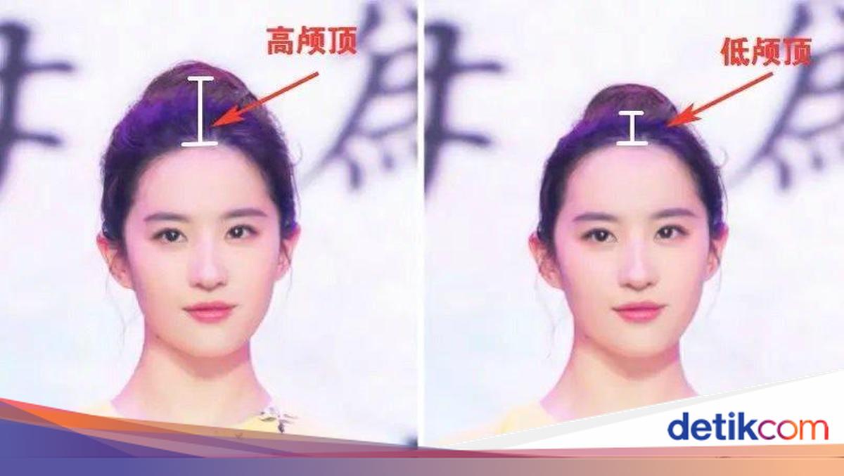Tren Kecantikan 'High Skull' Viral, Bentuk Kepala Tinggi yang Kontroversial