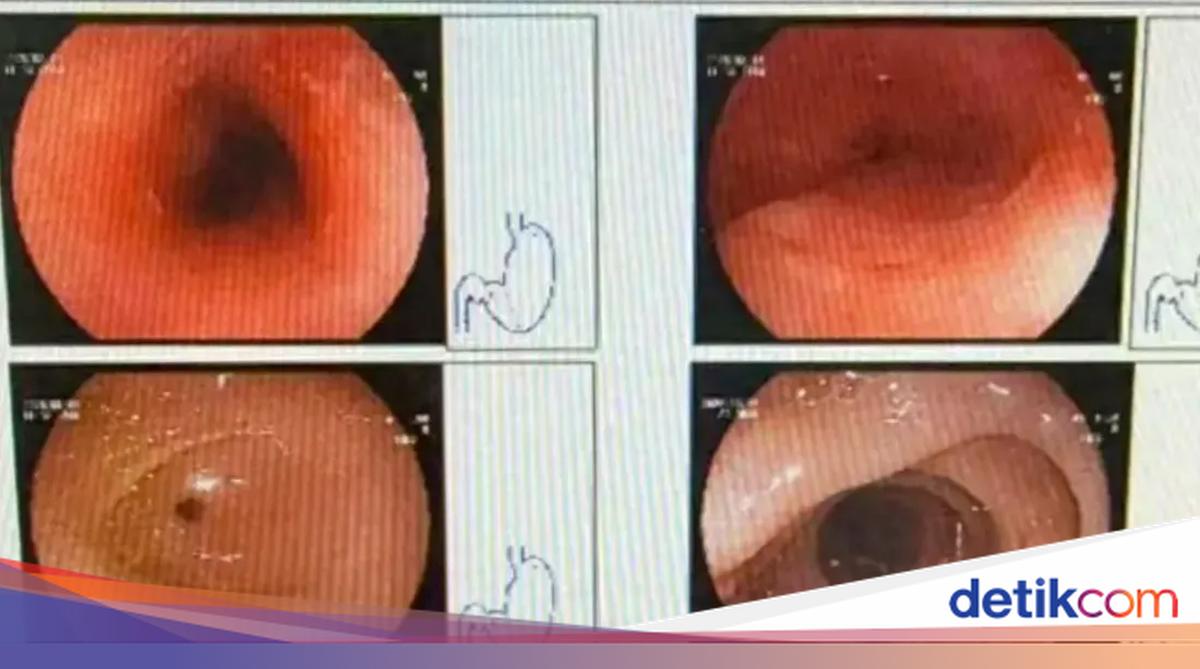 Gegara Makan Hotpot Panas, Kerongkongan Wanita Ini Luka Sepanjang 8 Cm