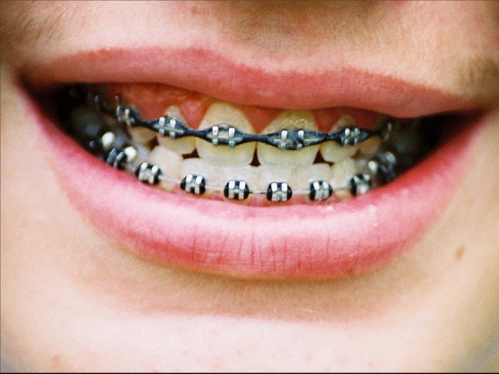Mau Pakai Behel Padahal Susunan Gigi Tak Bermasalah? Ini Kata Dokter