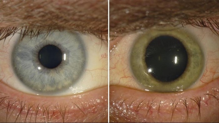 Risiko Penyintas Ebola, Mulai dari Nyeri Sendi Hingga Kebutaan