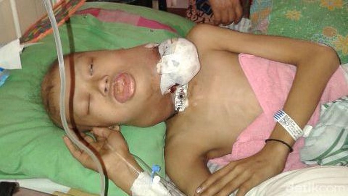 Bocah Penderita Kanker Laring Memilukan, Ini Reaksi Dinkes Situbondo