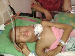 Bocah Penderita Kanker Laring Memilukan, Ini Reaksi Dinkes Situbondo