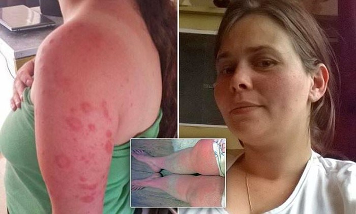 Idap Alergi Sinar Matahari, Kulit Wanita Ini Meleleh Tiap Keluar Rumah