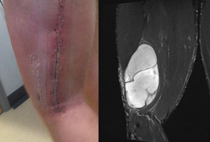 Dikira Berotot, Ternyata Ada Tumor di Kaki Kiri Binaragawan Ini