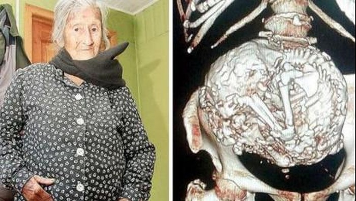 Wanita Ini Tak Sadar Tubuhnya 50 Tahun Membawa Janin Mati