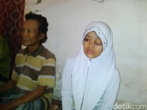 Akibat Kanker Otak, Mata Gadis Pasuruan ini Bengkak