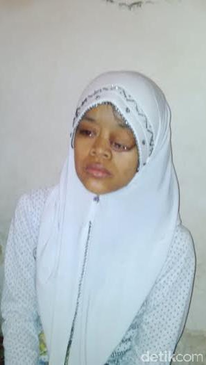 Akibat Kanker Otak, Mata Gadis Pasuruan ini Bengkak