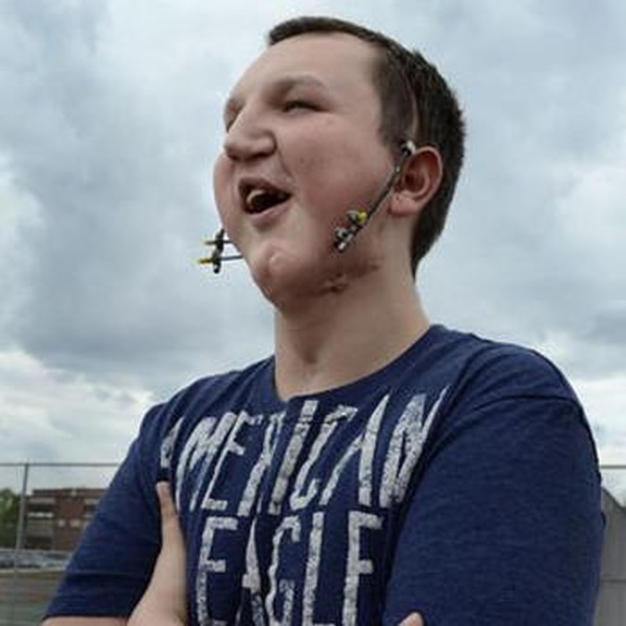 Rumitnya Mengatasi Kondisi Langka yang Menyertai Dagu Kecil Bayi Kirana