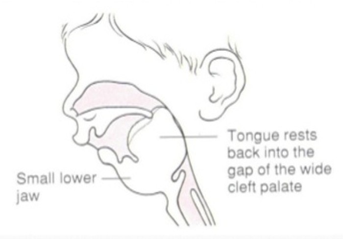 Pierre Robin Sequence, Kondisi Langka di Balik Dagu Kecil Kirana