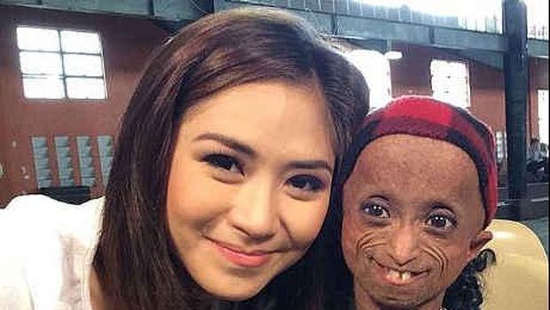 Salah satu pasien progeria asal Filipina (Foto: admn)