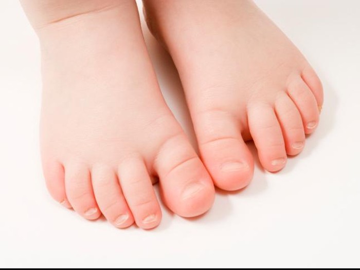 Kaki Balita Ini Melepuh Usai Injak Mainan Logam karena Kondisi Suhu Ekstrem