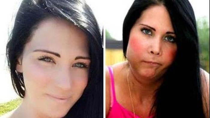 Mimisan Hebat Dikira Alergi, Ibu Satu Anak Ini Ternyata Kena Kanker