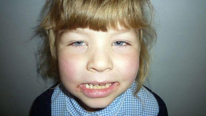 Idap Alergi Pasir, Kulit Bocah Ini Merah dan Terbakar Tiap Pergi ke Laut