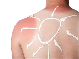 Bahaya Sinar UV Ekstrem: Sunburn hingga Kanker Kulit