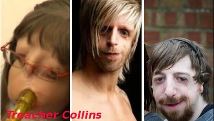 Si Kecil Belum Juga Lancar Bicara, Ternyata Ada Kelainan Struktur Wajah