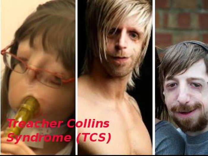 Bagaikan Lotre, Beginilah Kelainan Genetik Langka Diwariskan