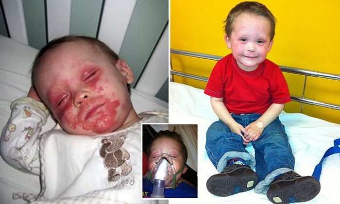 Idap Eksim Parah, Bocah 5 Tahun Ini Berkata Lebih Baik Dirinya Meninggal