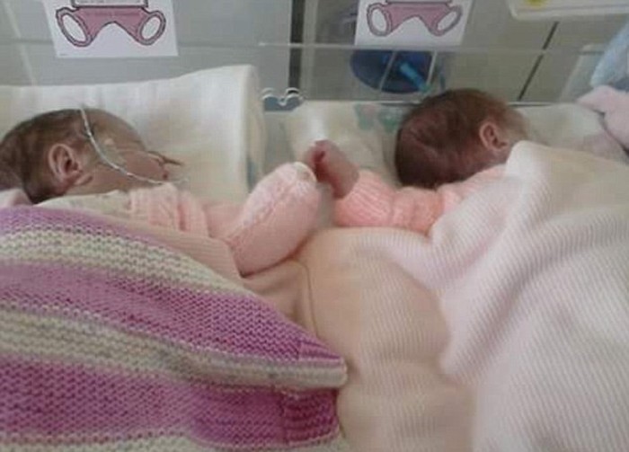 Berjuang Hidup, Kembar Prematur Ini Bergandengan Tangan di Inkubator