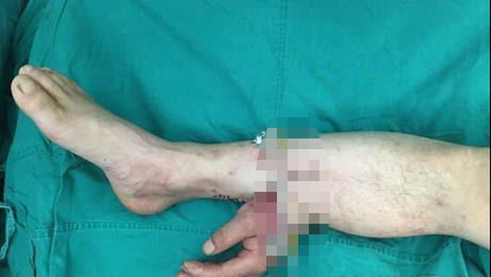 Tangan Pria Tionghoa Sukses Disambung Lagi Setelah Ditempelkan ke Kaki
