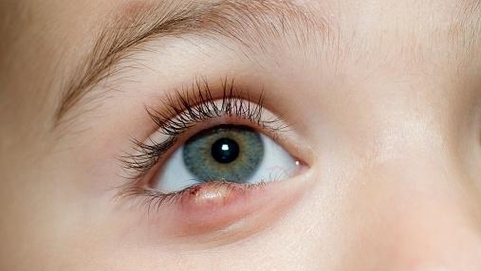 bintitan 1 Toddler girl showing sty on her eye